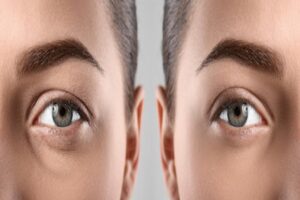 upper blepharoplasty